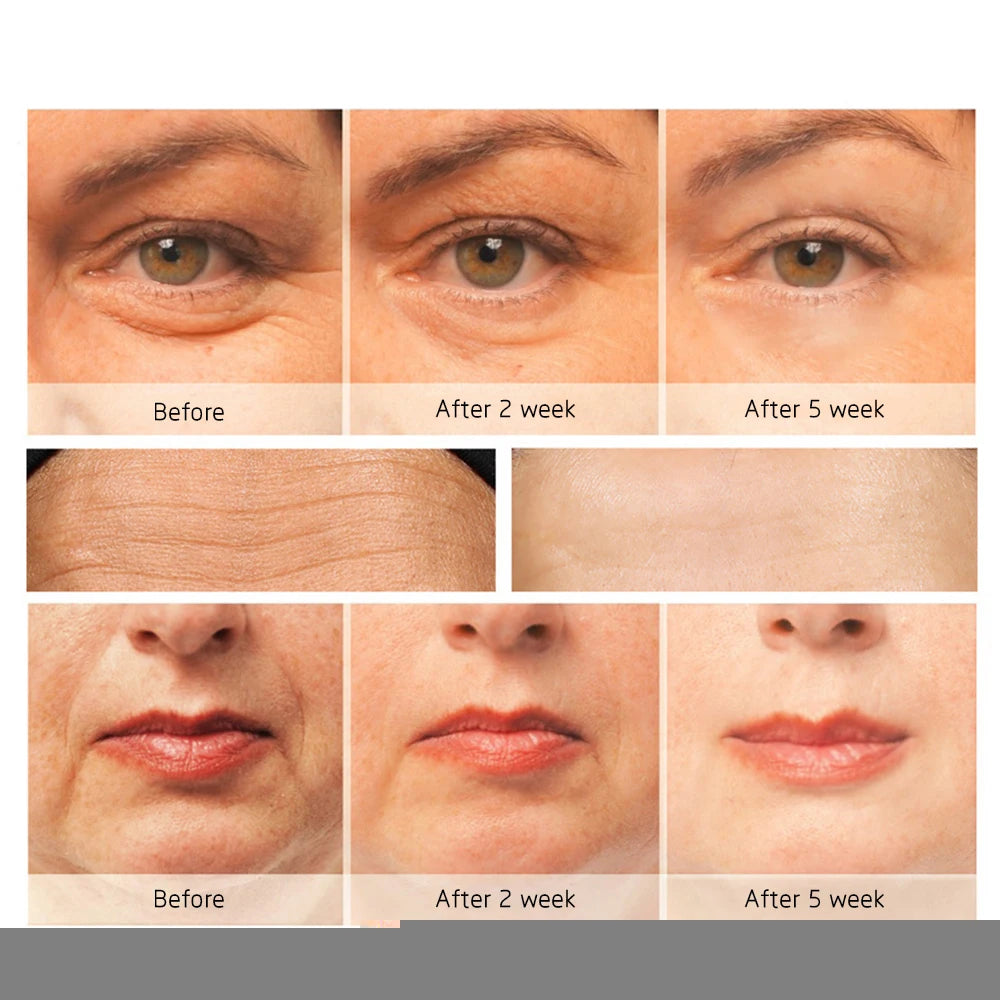 Sheluxe anti ageing eye wrinkle remover before and after photos showing reduced wrinkles over 5 weeks